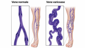 Comparație între vene normale și vene varicoase în picioare.